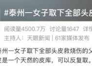 父亲重度烧伤，22岁女子取全部头皮救父！网友：亲情可以浓烈到无法想象